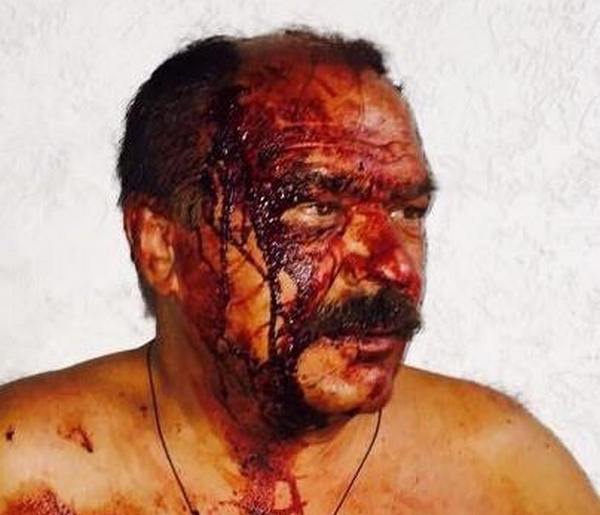 Сильно избит еще один активист выступающий против уничтожения зеленых зон Ирпеня (фото)