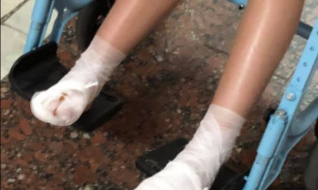 В Вышгороде сотрудники платного водного аттракциона не оказали помощь ребенку с ожогами ног (фото)